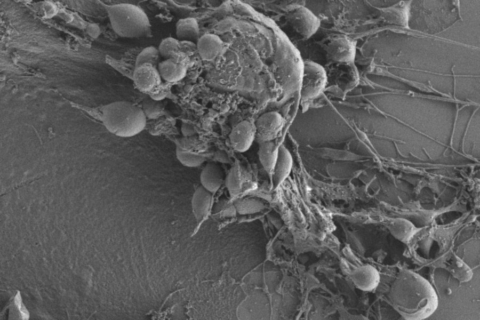 cancer-cervell UAB