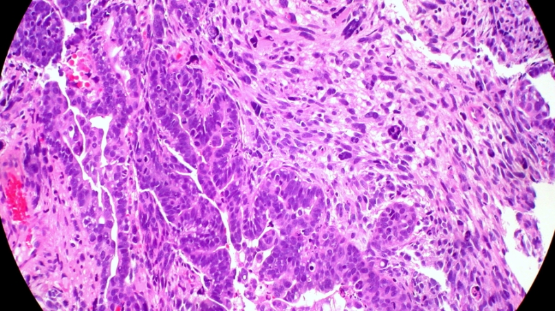 tumor endometri_Ed Uthman